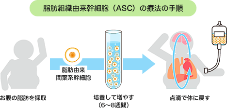 脂肪組織由来幹細胞(ASC)の療法の手順